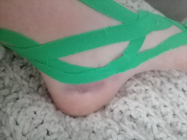 Skúsenosti s modrinami po plastike skríženého väzu