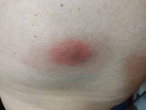 Od čoho je tento štípanec?