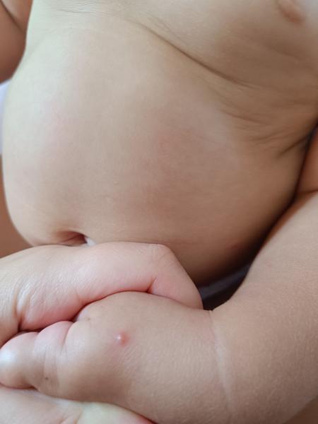 Sú vyrážky u detí spôsobené štípancami?