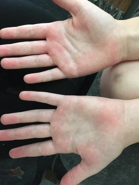 Vysyp na detských dlaniach po užití Cefzilu?