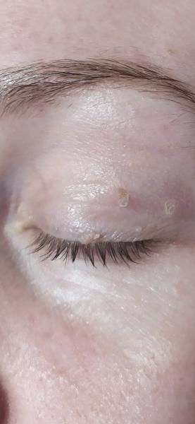 Dá sa odstrániť fibróm z viečka?