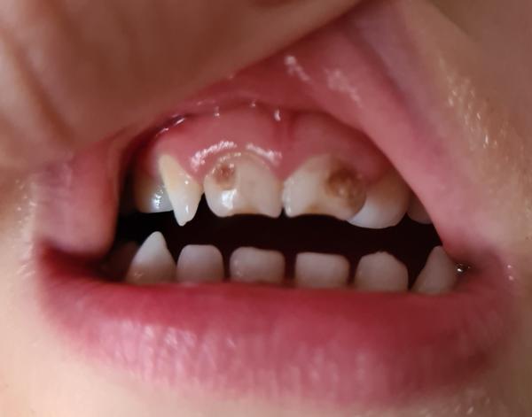 Trojročnému synovi vyšli predné mliečne zuby bez skloviny. Ako mu môžem pomôcť?