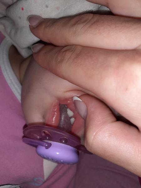 Ako riešiť odlomený predný zubček u 15 mesačnej dcérky?