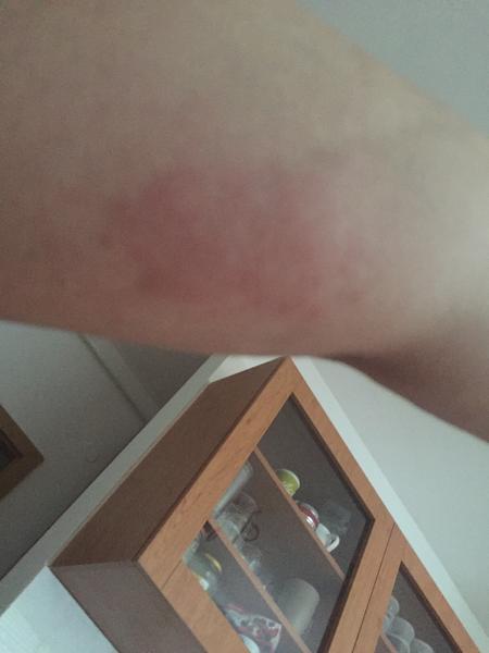 Zvláštna vyrážka na ruke v 31. týždni. Čo to je?