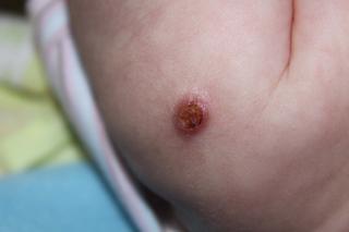 Musíme odložiť plávanie kvôli reakcii po očkovaní proti TBC?