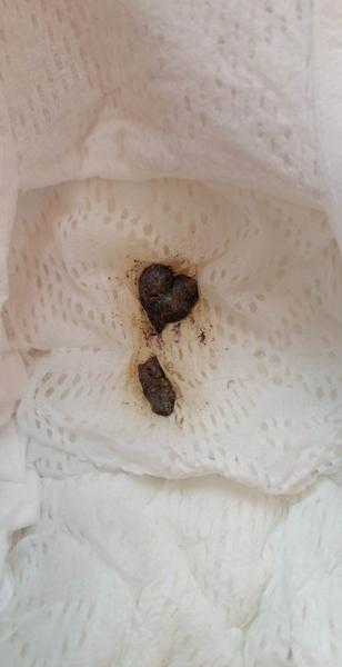 Stolica u 5-mesačného dieťaťa