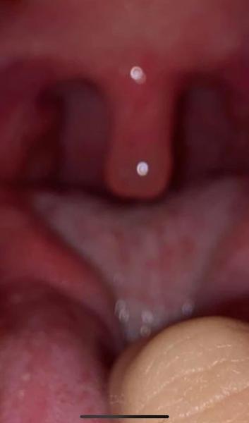 9 ročná dcéra má nádchu a nedá sa jej prehĺtať