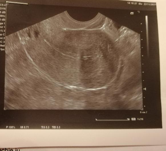 Mám zrasty v maternici a idem na hysteroskopiu. Čo je vidno na fotke zo sona?