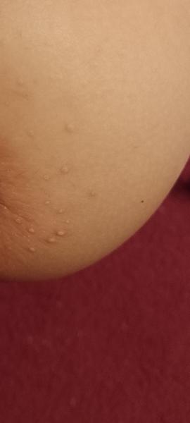 Prečo má moja 2-ročná dcéra vyrážky?