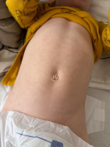 Čo spôsobuje výsyp pri horúčkach?