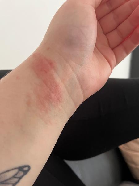 Ako sa zbaviť svrbiaceho kožného problému na ruke?