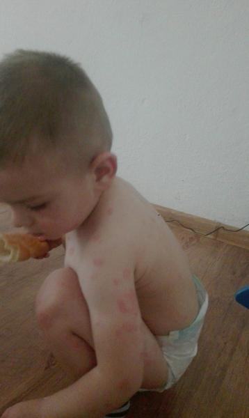 Červené fľaky po tele