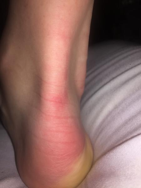 Bolesť chodidla - mám zápal šliach?