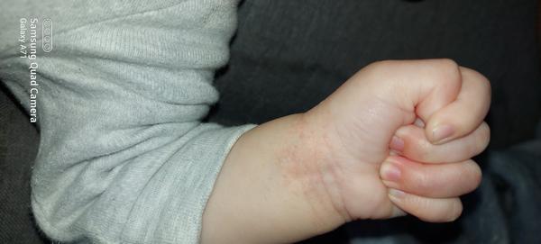 Má môj trojmesačný synček ekzém?