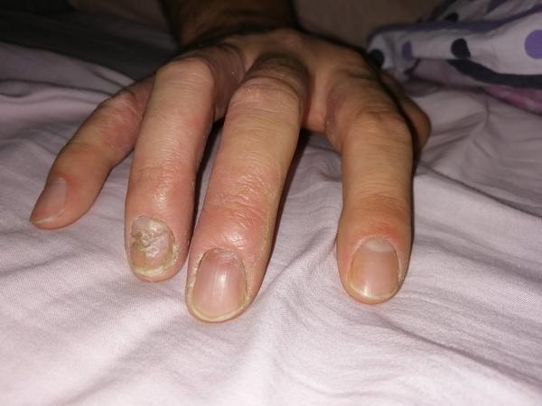 Pleseň na rukách - liečba