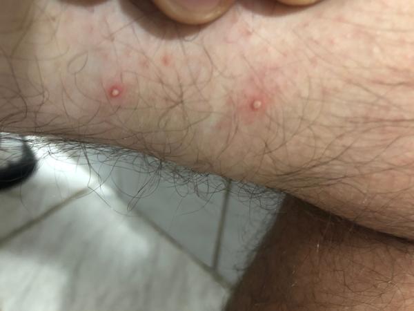 Malé vyrážky na stehnách a lýtkach. Môže to byť alergia?