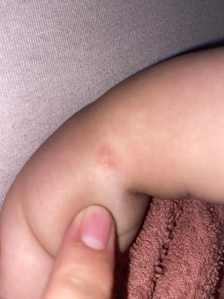 Čo spôsobuje vyrážky u 6-mesačnej dcéry?