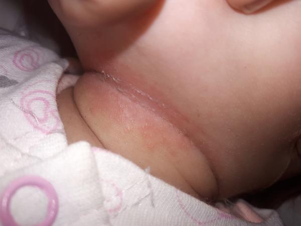 Akú masť mám dať trojmesačnej dcérke?