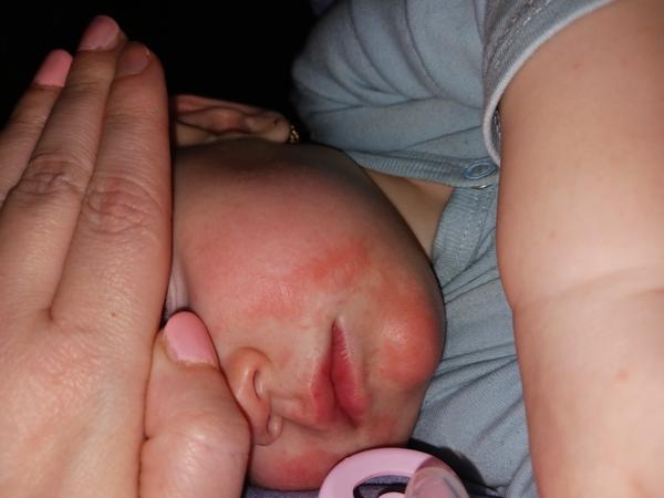 Červené fľaky na tvári dieťaťa: Čo ich spôsobuje?