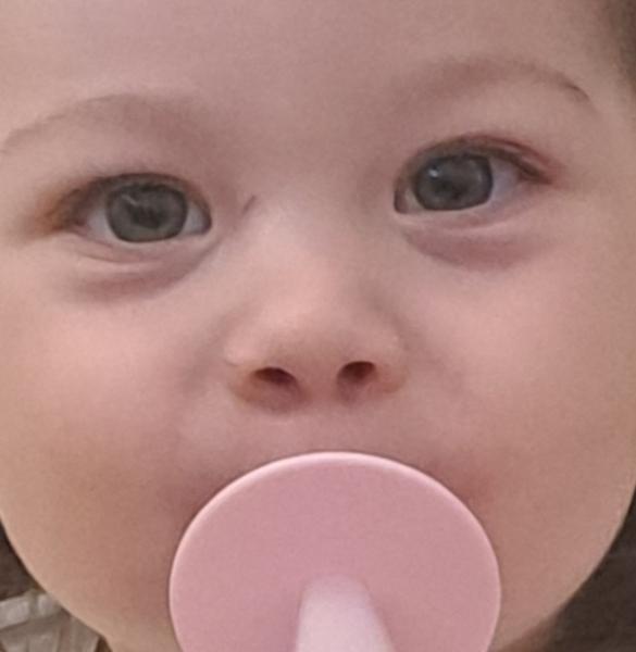 Pomoc s poruchou zraku u 18-mesačného dieťaťa