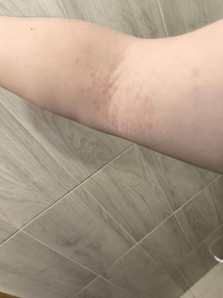 Sú to potničky na vnútornej strane lakťa?