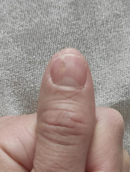 Aký fľak mám pod nechtom?