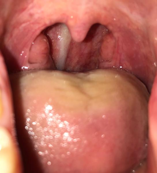 Zatekajúci hlien v hrdle