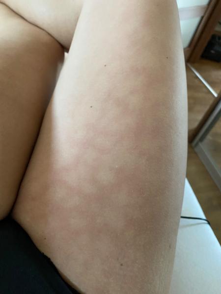 Fľaky po opaľovaní