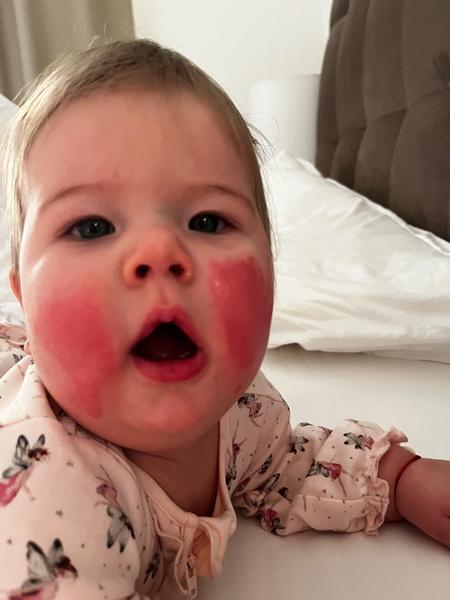 Ako zabrániť tvorbe výrazného erytému u 9-mesačnej dcérky?