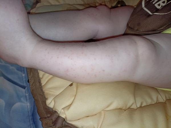 Fialové fľaky na nožičkách