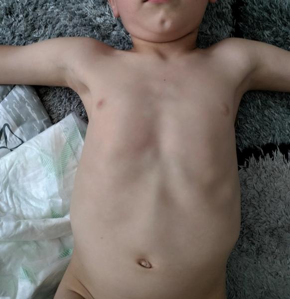 Je to diastáza u dieťaťa?