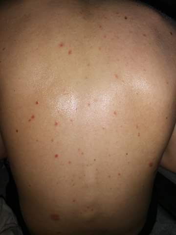 Čo znamenajú malé červené vyrážky na chrbáte?