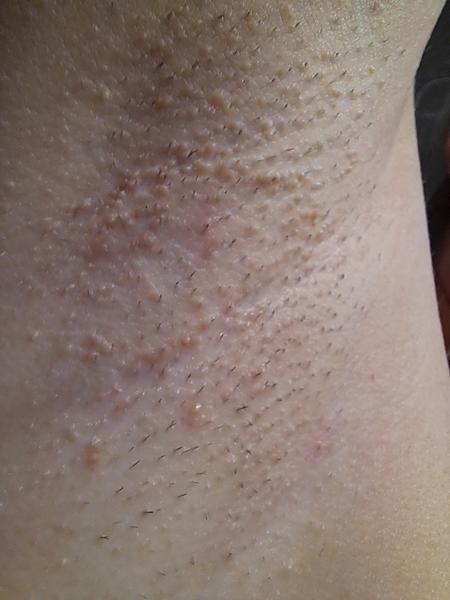 Sú vyrážky pod pazuchami z holenia alebo potničky?