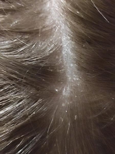 Ako zistiť, či sú vši skutočne preč?