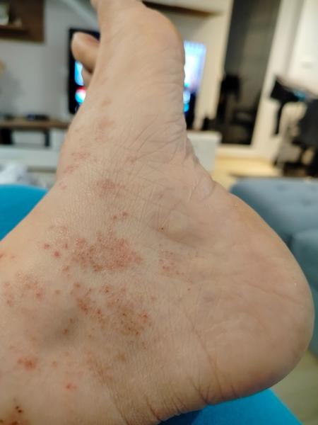 Vyrážky na nohách s normálnymi krvnými testami: Čo môže byť príčina?