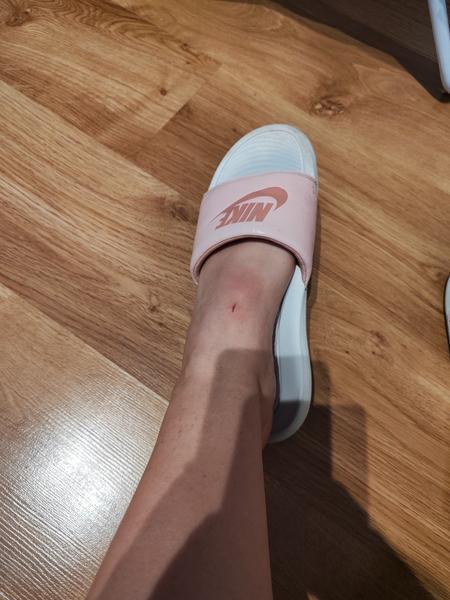 Je opuch nad ranou dôvodom na obavy?