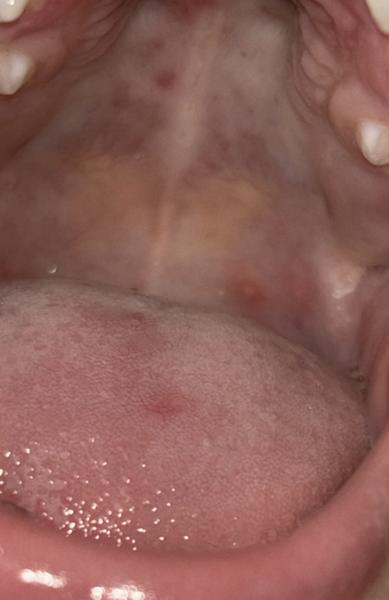 Čo znamenajú červené pupienky v ústach?