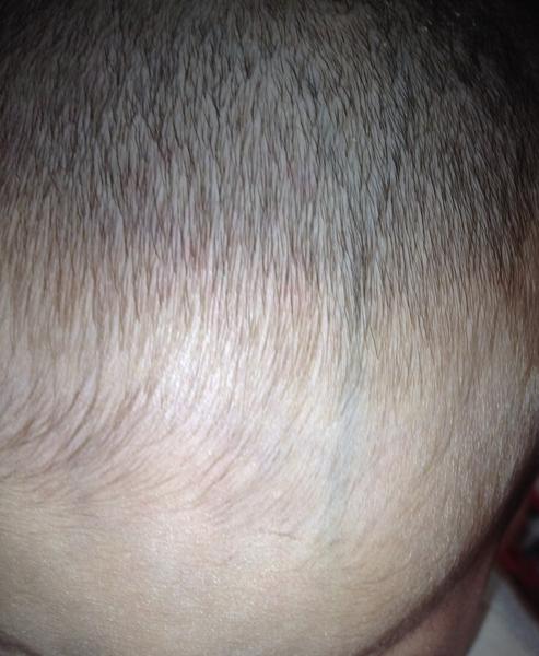 Čo znamenajú žilky od čela k temenu?