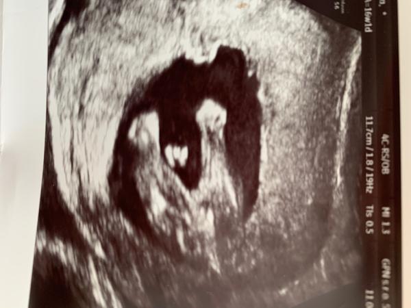 Aké je pohlavie môjho dieťatka?