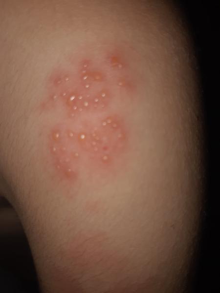 Aký problém znamená zhluk vyrážok u 7-ročného syna?