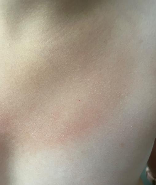 Červené bodky u detí