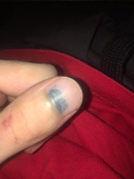 Mám ísť k doktorovi, keď mi sčernel palec?