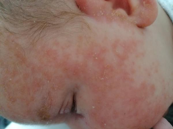 Aké vyrážky má môj 5 týždňový syn na tvári?