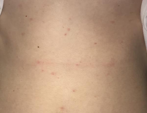 Vyrážky na bruchu a hrudi