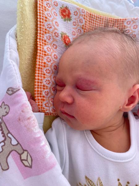 Čo znamenajú červené horné viečka u bábätka?