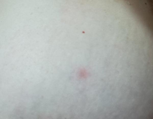 Máte skúsenosť s vyrážkou na prsníku?