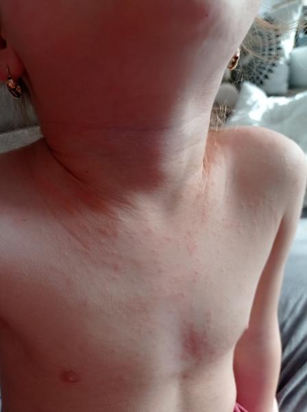 Kožné prejavy Covidu u detí