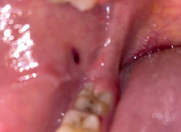 Červeno-fialová vec na líci v ústach