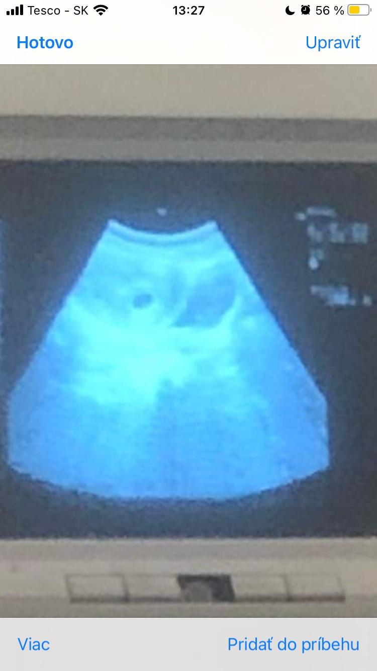 Ultrazvuk v 6. týždni dvojičky Modrý koník