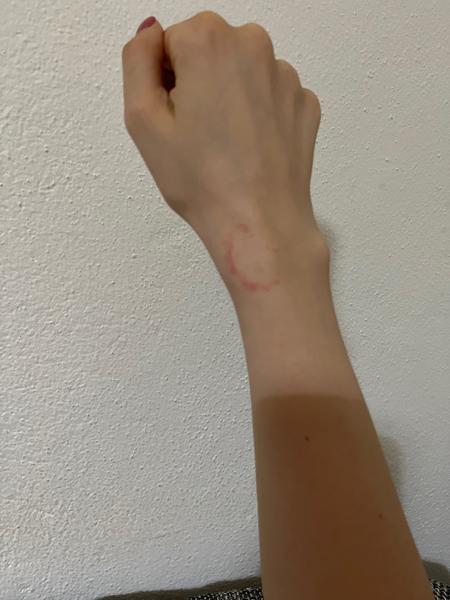 Ide o nedostatočne doliečenú boreliózu?